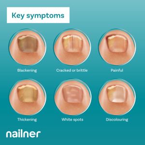 Nailner Fungal Nail Treatment Brush, 5ml – Antifungal Solution
