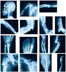 Sayglossy 15 Pcs Broken Bones x Ray Set Human x Rays Black and Blue Skeleton Pretend Xrays for Kids