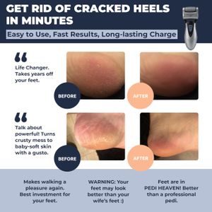 Own Harmony Electric Callus Remover – Rechargeable Foot File