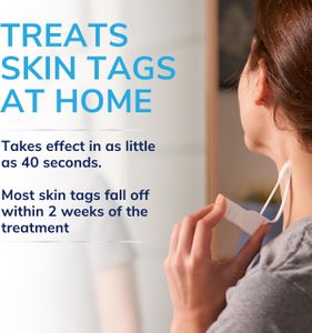 Scholl Skin Tag Removal Kit – Easy At-Home Remover