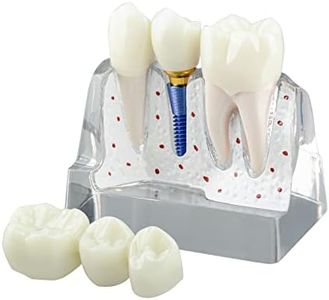 Ultrassist Dental Implant Model for Patient Education, 4 Times Dental Implant, Crown and Bridge Model for Presentation-Transparent