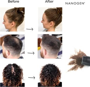 Nanogen Hair Fibres Dark Brown – Instant Hair Thickening Solution
