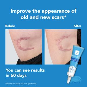KELO-COTE Silicone Scar Gel 15g – Treatment for Surgical, Burn & Acne Scars