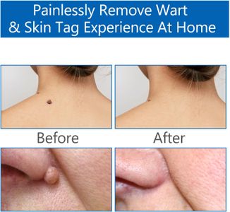 Skin Tag Remover Pen Kit – Safe Home Mole & Wart Removal Tool