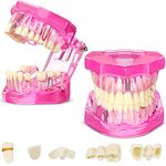 2 Pcs Disease Teeth Model Dental Typodonts Implant Teeth Model with Removable Teeth Dentist Standard Tooth Pathological Demonstration for Education Dental Supplies Assistant Accessories (Pink)