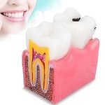 Dioche Dental Caries Teeth Model, S