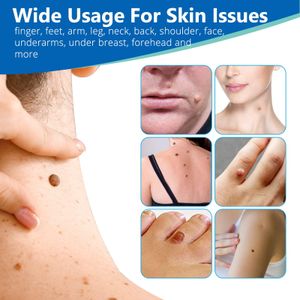 Skin Tag Remover Pen Kit – Safe Home Mole & Wart Removal Tool