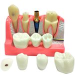 4 Times Dental Implant Model with Removable Crown Bridge Dental Veneers Porcelain Teeth for Stutent Study and Teaching Demonstration