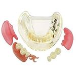 Dental Implant Typodont Restoration
