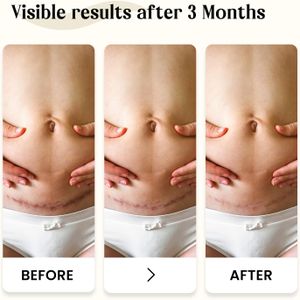 Dermatix Silicone Scar Gel 60g Tube – Scar Management Treatment