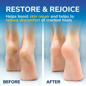 Scholl Cracked Heel Cream 60ml – Intensive Foot Repair