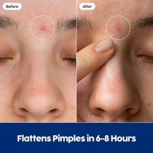 Patch Perfect Hydrocolloid Pimple Patches, 102 Count – Acne Spot Treatment