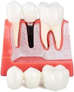 LVCHEN Dental Implant Model - 4 Times Crown Bridge Explanation Model Implant Analysis Tooth Model Removable Crown Cross-Section Demonstration for Study and Teaching