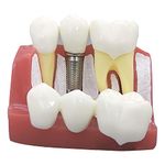 4 Times Dental Implant Model Removable Analysis Crown Bridge Demonstration Teeth Model