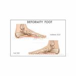 Anne Print Solutions® Deformity Foot Chart Posters Without Frame Hospital Posters for clinic wall medical posters for patients Pack Of 1 Pcs Size 13 X 19 Inch* Multicolour (DEFORMITY FOOT)