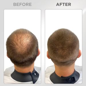 THICK FIBER Hair Fibres, Medium Brown – Instant Hair Thickening