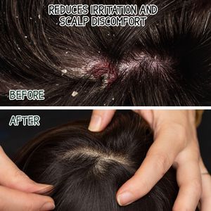 Milva Pine Tar Shampoo 500ml – Natural Anti-Dandruff for Seborrheic Dermatitis, Psoriasis, Dry Itchy Scalp
