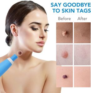 Skin Tag Removal Kit with 40 Bands – Easy At-Home Treatment