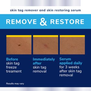 Scholl Skin Tag Removal Kit – Easy At-Home Remover