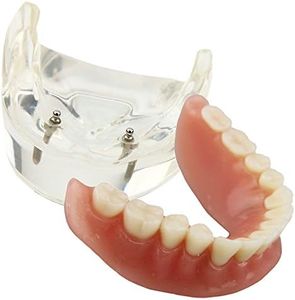 Smile1000 Dental Model Overdenture Inferior 2 Implants Demo for Studing and Teaching