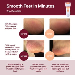 Own Harmony Electric Callus Remover – Rechargeable Foot File