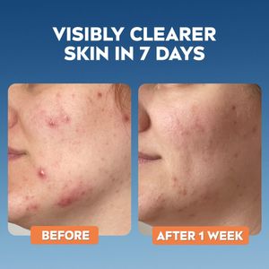 NIVEA Derma Skin Clear Face Scrub, 150ml – Exfoliating Cleanser