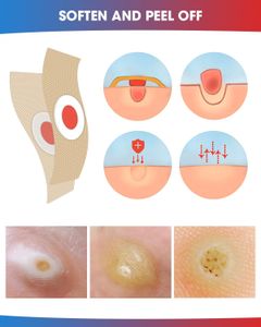 MYMULIKE Corn Removal Pads, 60 Count – Foot Callus Treatment