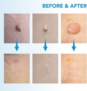 Skin Tag Removal Kit with 40 Bands – Easy At-Home Treatment