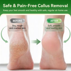 Electric Foot File Callus Remover – Rechargeable Pedicure Tool