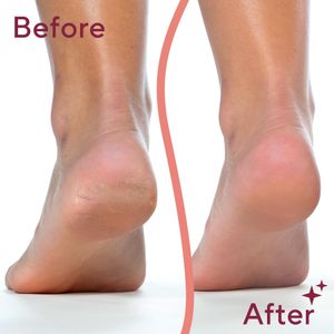 Finishing Touch Flawless Pedi Electronic Foot File – Callus Remover