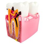 Dental Caries Teeth Model, 3.4 x 3 x 2 Inches - 6 Times Enlarged Dental Anatomy Education Tooth Model - Caries Teaching Typodont Tool for Dentists, Patients, Teachers, and Students