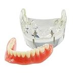 Dental Teeth Model Typodont Implant