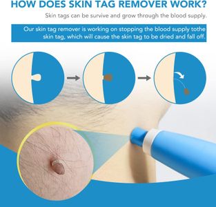 Skin Tag Removal Kit with 40 Bands – Easy At-Home Treatment