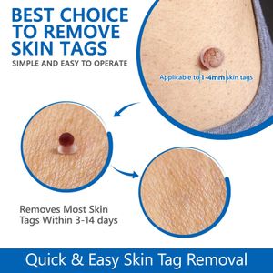 2-in-1 Skin Tag Remover Kit – Easy Home Removal Tool Set