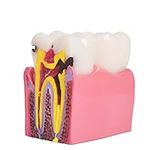 ANNWAH Dental Caries Teeth Model,De