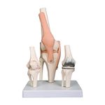 Knee Replacement Prosthesis