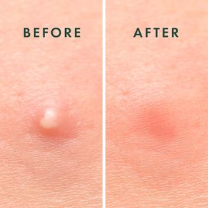 Rael Pimple Patches 96-Pack – Hydrocolloid Acne Spot Treatment