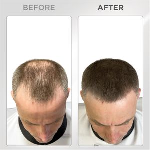 THICK FIBER Hair Fibres, Medium Brown – Instant Hair Thickening