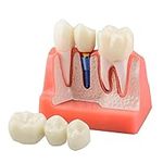 Ultrassist Dental Implant Model for