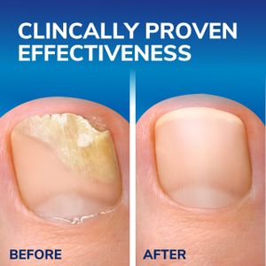 Scholl Fungal Nail Treatment Kit – Effective Nail Repair Solution