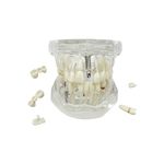 Transparent Disease Teeth Model, YOUYA DENTAL Transparent Dental Implant Teeth Model Dentist Standard Disease Removable Tooth Pathological Teaching Model