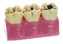 LABZIO by EISCO - Staged Model of Decaying Tooth, Removable and Dissectible Teeth, 7 Parts, Enlarged for Better Observation