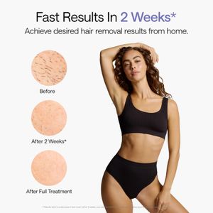 Ulike Air 10 IPL Hair Removal Device – Painless Permanent Results