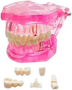 Windplusya Transparent Disease Teeth Model with Dental Implant Bridge, Dental Teach Crown Bridge Removable Model, Tooth Model for Patient and Dental Student Education. (Red)