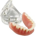 Dental Model Overdenture Inferior 4 Implants Demo for Teaching and Studying