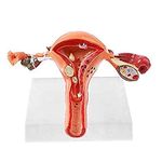 KKI Female Uterus with Ovary Pathological Anatomical Model | Diseased 3d Anatomy of Human Reproductive System perfect for Medical Students and Training