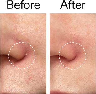 INKEY List Hydrocolloid Pimple Patches – Acne Spot Treatment