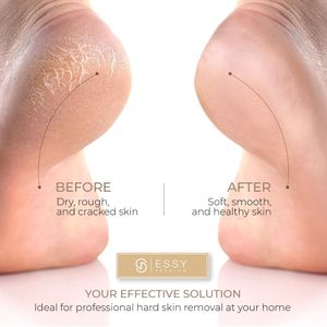 Essy Electric Foot File – White Pedicure Callus Remover