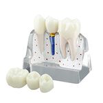 Ultrassist Dental Implant Model for Patient Education, 4 Times Dental Implant, Crown and Bridge Model for Presentation-Transparent