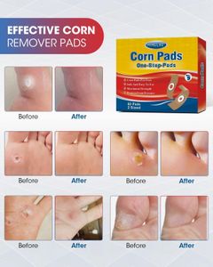 MYMULIKE Corn Removal Pads, 60 Count – Foot Callus Treatment